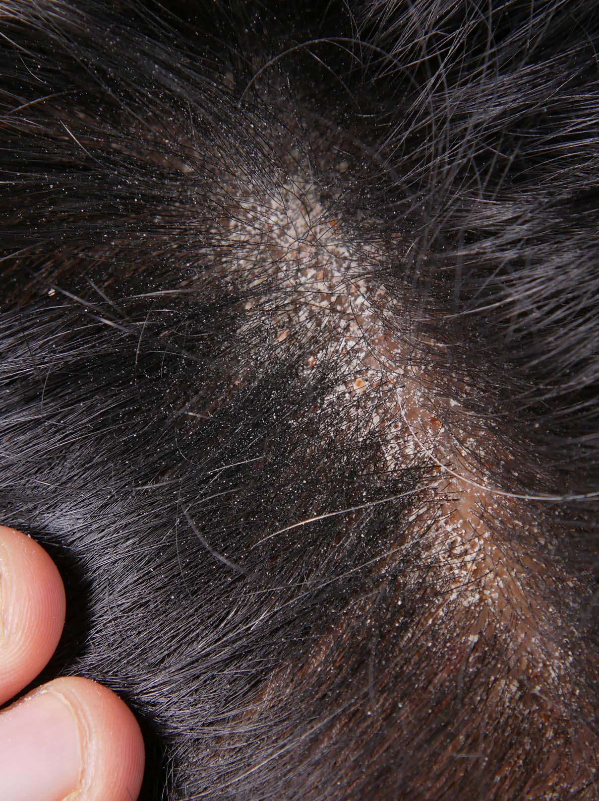 Coconut Oil for Dry Scalp and Dandruff