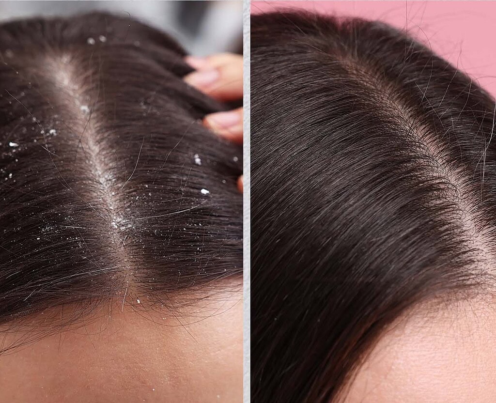 Dry Scalp vs. Dandruff